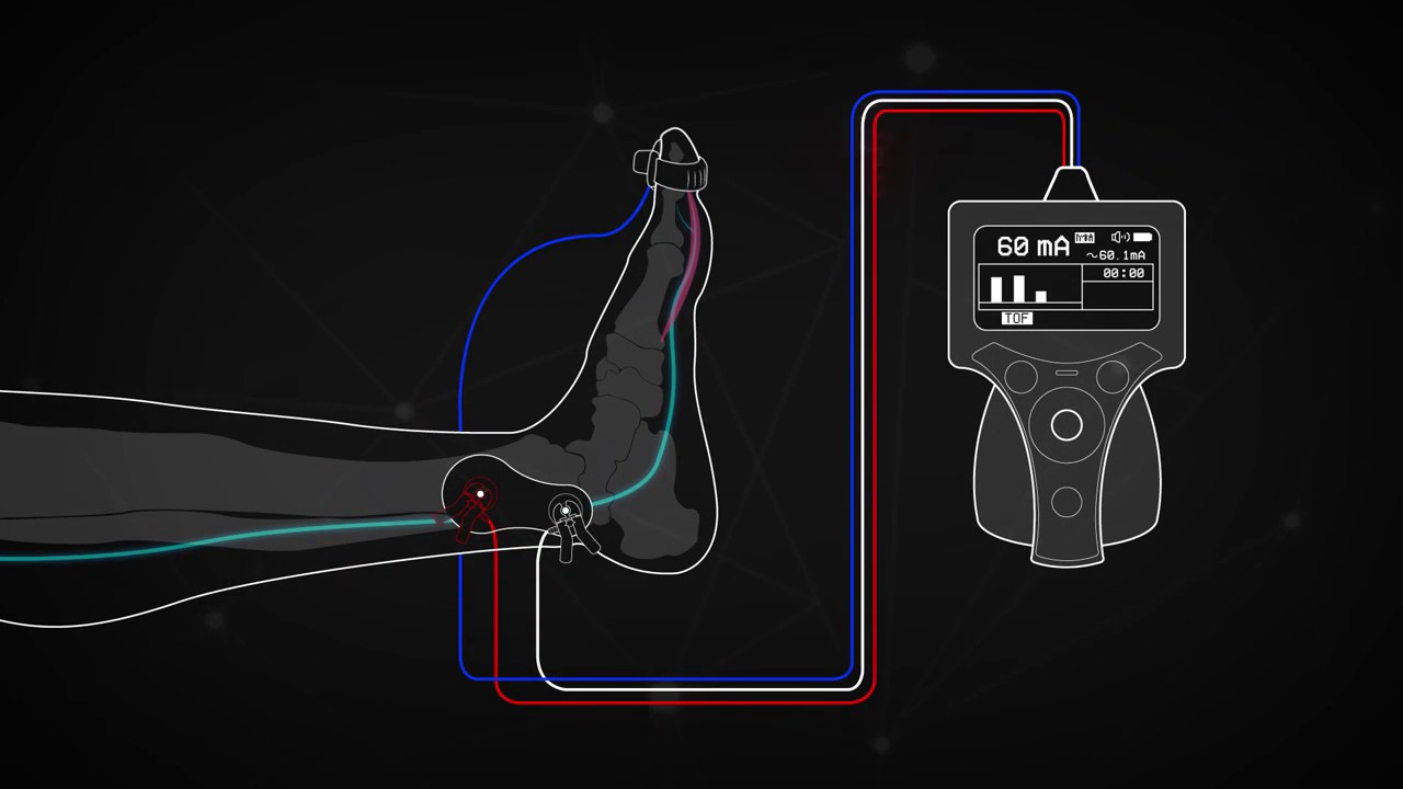 train-of-four-monitoring-using-the-posterior-tibial-nerve-youtube