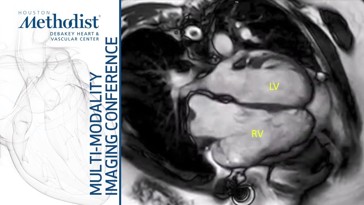 Congenital Heart Disease II: Imaging of Complex Congenital Lesions (V. Duarte, MD) March 29, 2022