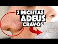 REMOVENDO CRAVOS DO NARIZ EM MINUTOS #3 - 5 TÉCNICAS CASEIRAS QUE FUNCIONAM | KIM ROSACUCA