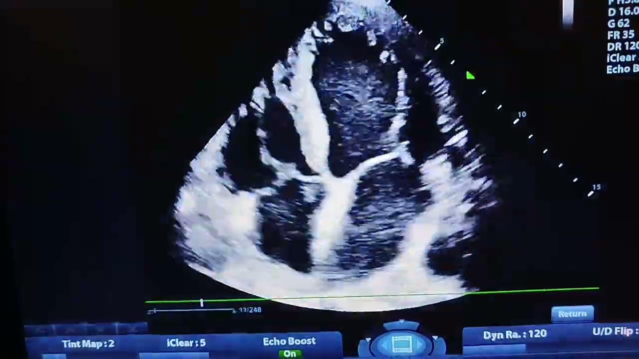 Ischemic Dilated Cardiomyopathy & Severe MR & DDG III& Moderate AR&Severe TR & Severe PHTN