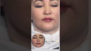 #контурнаяпластика #skincare #уходзажирнойкожей #красотаназдоровье #lips #aesthetic #эстетическая