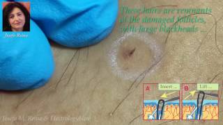 Josefa: Blackheads and Ingrown Hairs