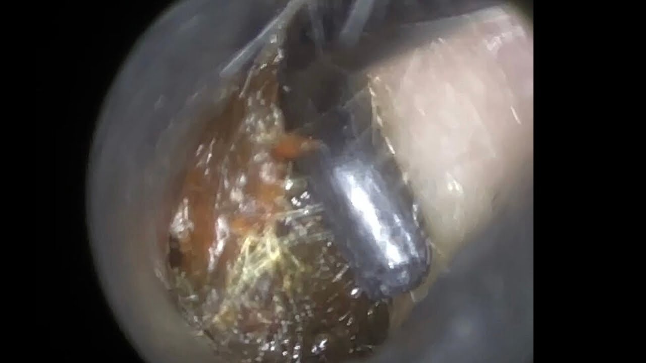 51 Ear Hook Removal of Hard Ball of Ear Wax using the WAXscope®️
