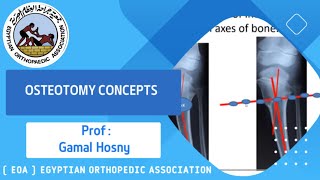 osteotomy concepts .(Prof.Dr Gamal Hosny) screenshot 1
