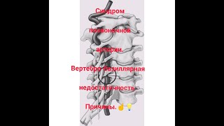 Синдром позвоночной артерии. Вертебро-базиллярная недостаточность.