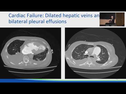 The Liver in Cardiac Disease