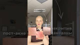 Сыворотка WW436802 уходзалицом закрытыекомедоны прыщи постакне РП