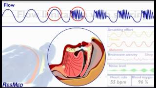 Understanding SDB - Flow Limitation with Snoring