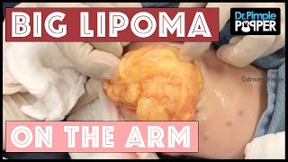 A HUGE Arm Lipoma removed by Dr Pimple Popper