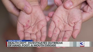 Health Dept. Investigates Outbreak Of Hand, Foot, And Mouth Disease