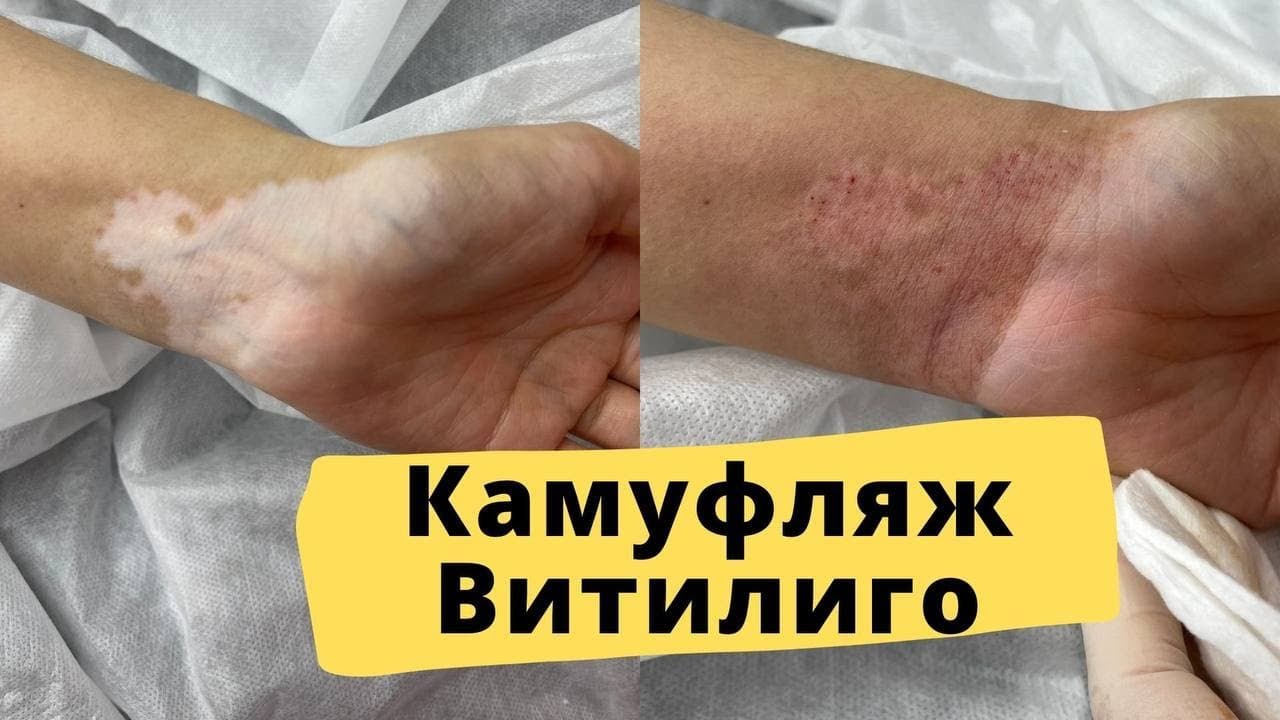 ВИТИЛИГО можно вылечить? Подбор пигментов, процесс камуфляжа витилиго и ...