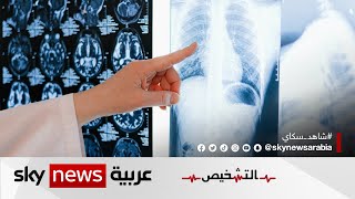 سرطان الرئة..الأعراض والعلامات الأولية للإصابة | #برنامج_التشخيص