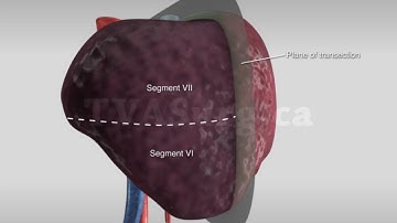 Segment VI/VII resection