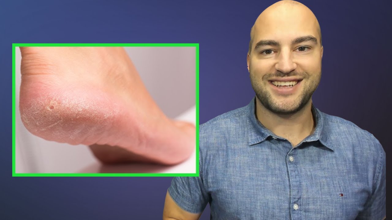 How to Treat Corns and Calluses YouTube