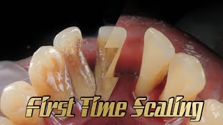 First Time Scaling | Karang Gigi | Tartar removal | Male 50 y.o. |@dentist_ruli