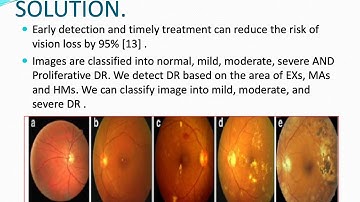 Detection of Diabetic Retinopathy using Image Processing Techniques