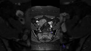 SI Joint MRI: Don’t Confuse These Entities#msk#mri#radiology#pain#lowbackpain#sijoint#sacroiliac