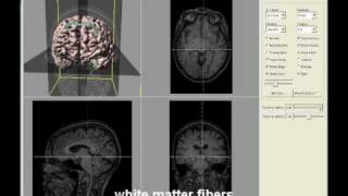 3D Visualization of Brain DTI Data