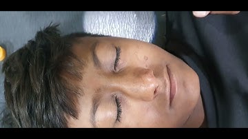 Nasal bone fracture reduction - Dr Hitesh Patel