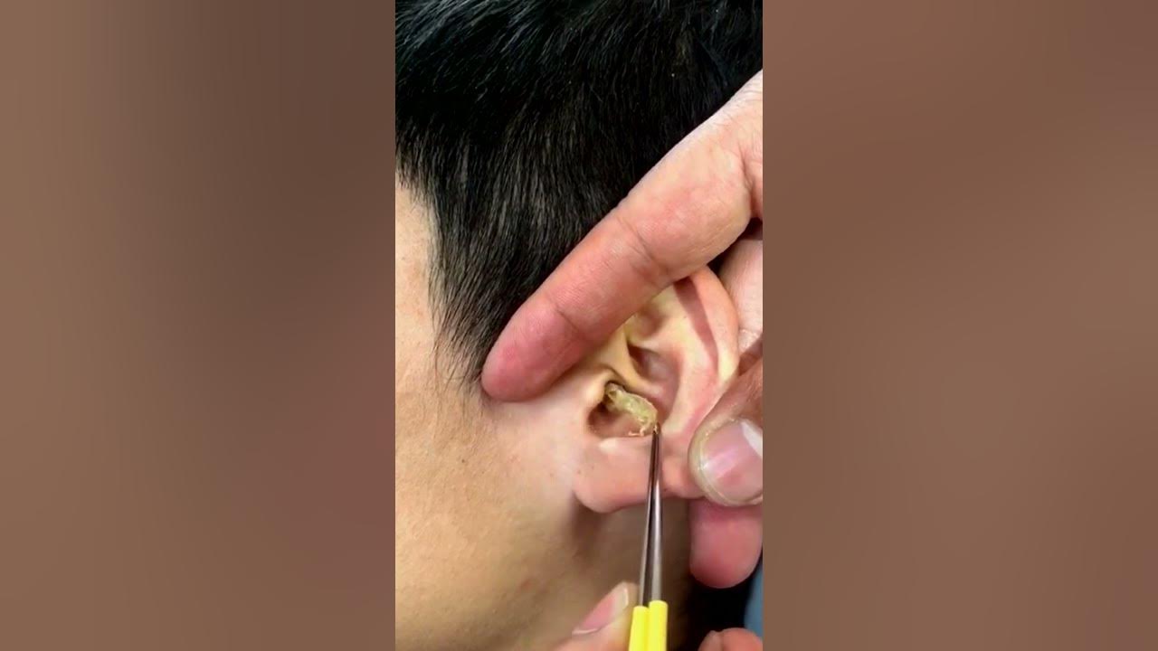 New pimple extraction videos Loan nguyen new pimple popping videos