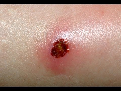 what is mrsa infection and its natural treatment youtube mercer illness