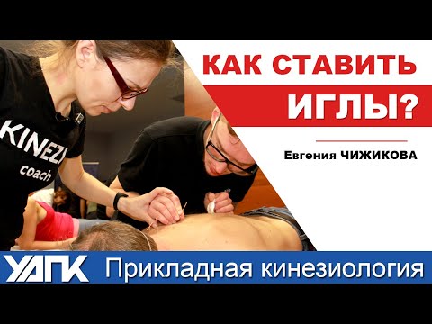 Как ставить иглы правильно? (Е.Чижикова)