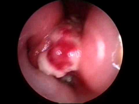 squamous cell carcinoma on nose #11