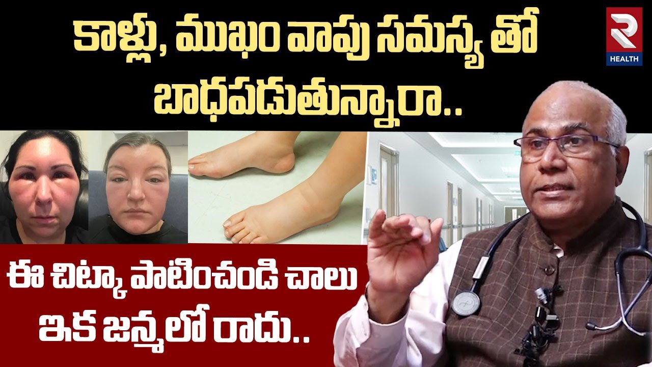 కాళ్లు, ముఖం వాపు సమస్య తో బాధపడుతున్నారా.. | Dr. CL Veankat Rao About Leg Swelling | RTV Health