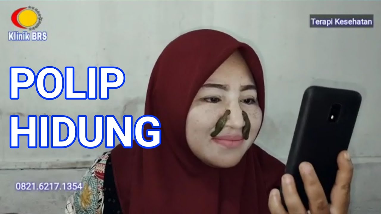 Polip hidung 