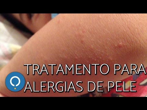 Tratamento natural para ALERGIAS DA PELE