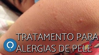 E coxa queima comichão