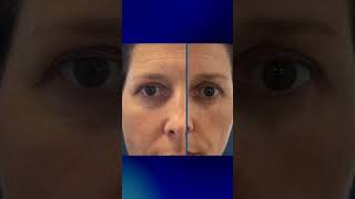 Deep Sulcus Treated In Just 10 Minutes