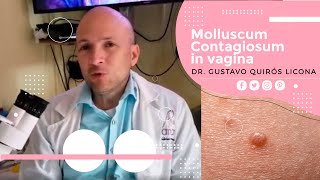 Molusco Contagioso En Vagina. Molluscum Contagiosum In Vagina