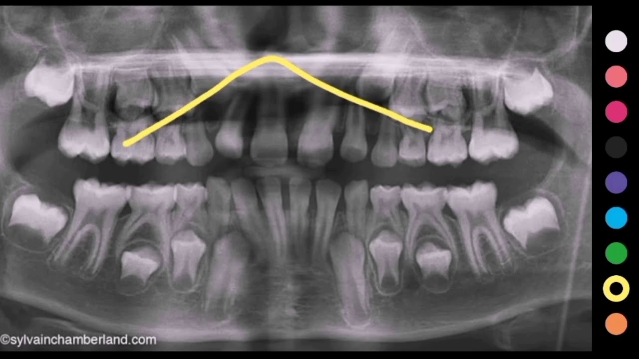 ترتيب بزوغ الأسنان عند الأطفال