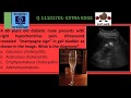 CHAMPAGNE SIGN- EMPHSEMATOUS CHOLECYSTITIS- ULTRASOUND