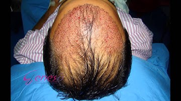 Follicular Unit Transplantation (FUT) Surgery - 4 | Hair Transplant | Dr. Anand Joshi