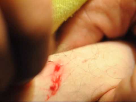 Popping A Pus Pocket Caused By An Ingrown Hair And See It Bleed