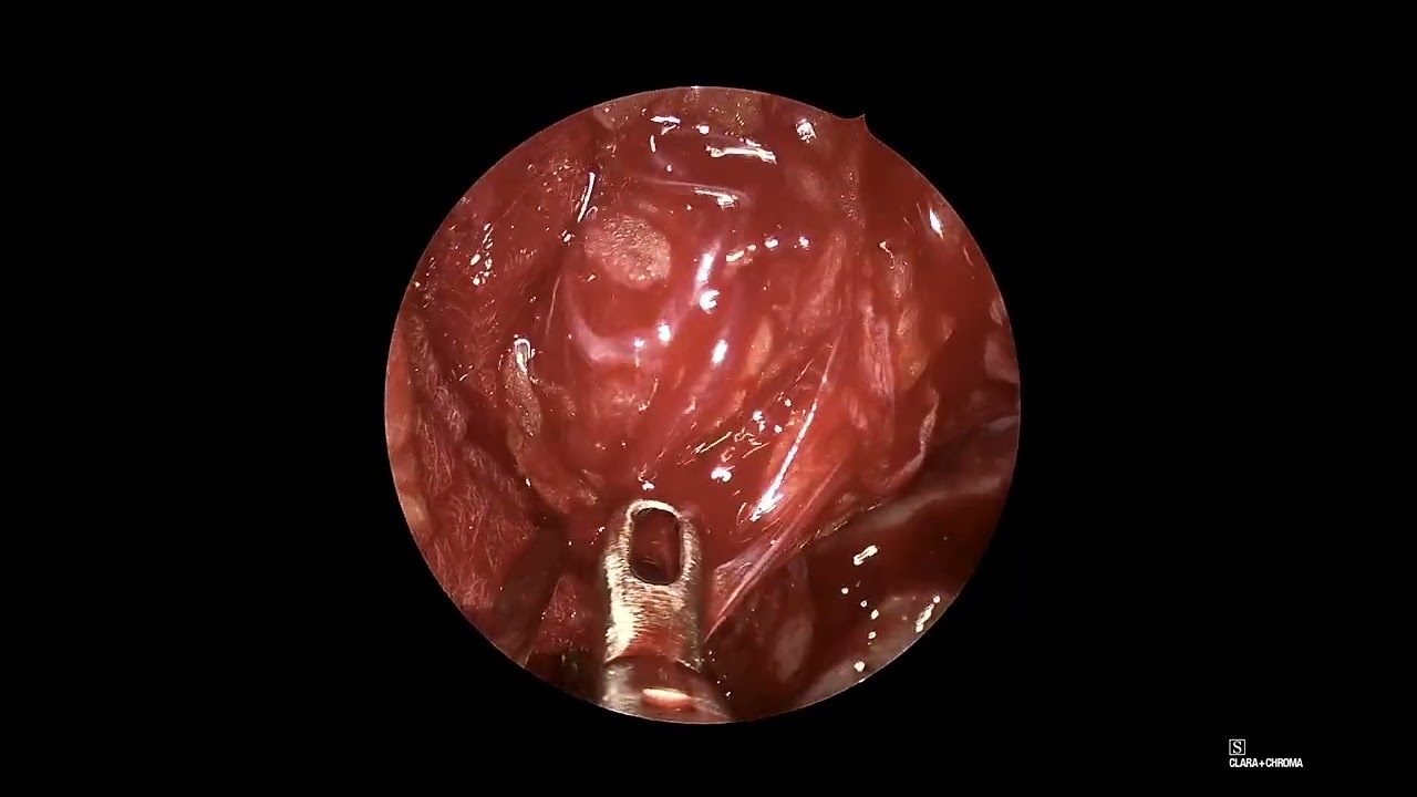 Endoscopic Endonasal En-Bloc Resection of Orbital Solitary Fibrous Tumor