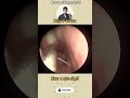 크리스마스 이브 특집 축농증청소 (Christmas special sinusitis cleaning)