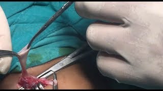 عملية فتق اربى خِلْقى فى طفل عمره سنة   Congenial inguinal hernia فيديو 32 قناة د/ أيمن زغلول هزاع