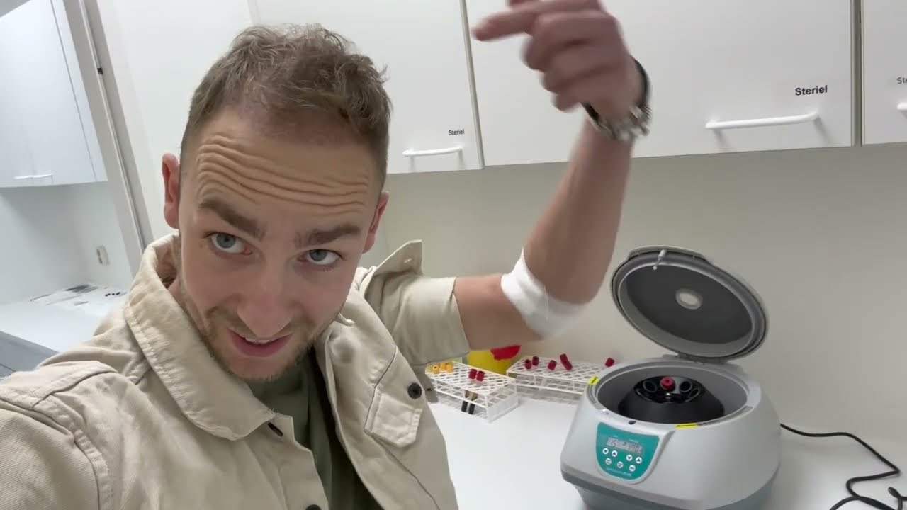 Deel 4 van Rick's DHI (ongeschoren) haartransplantatie proces