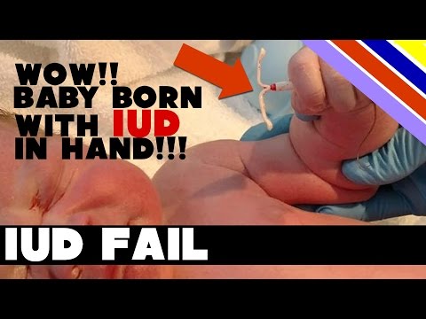 IUD Fail!! - Baby born with IUD in hand!