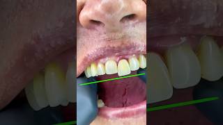 You will love this flexible dental prosthesis #mrdent #dentist #smile #viral