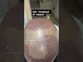 Hair transplant surgery in Pakistan
