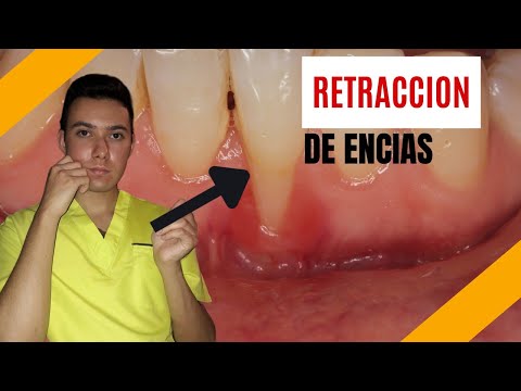 Video: Cum să preveniți retragerea gingiilor: 10 pași (cu imagini)