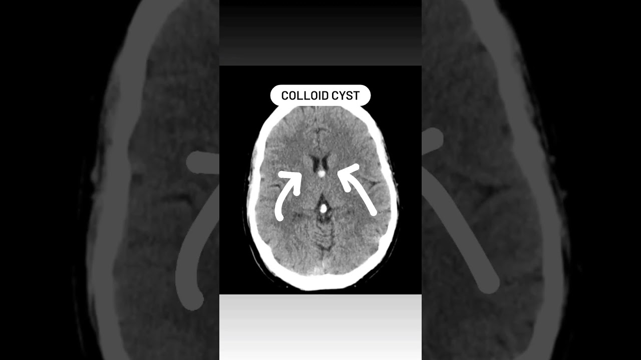 Colloid Cyst CT Brain 