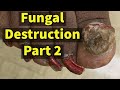 Fungal Nail Destruction, Part 2: Making Progress! Toenail Fungus Under Nail Polish