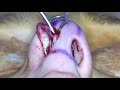 Domes Technique for Nasal Tip Rotation in Rhinoplasty