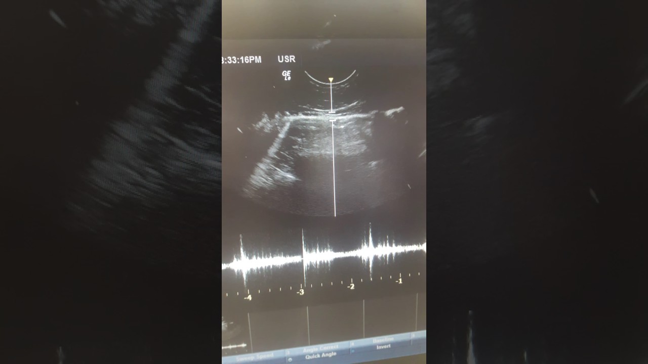 lung pulse on ultrasound YouTube
