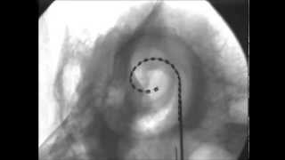 2014 Cochlear Implant electrode insertion